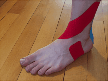 Kinesio-Taping